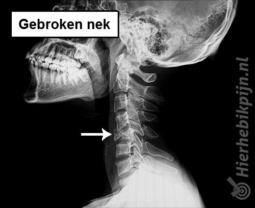 Rontgenfoto gebroken nek nekwervel fractuur